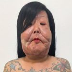 Juju do Pix mostra rosto após terceira cirurgia para retirar óleo mineral
