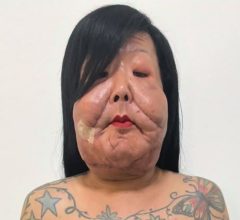 Juju do Pix mostra rosto após terceira cirurgia para retirar óleo mineral