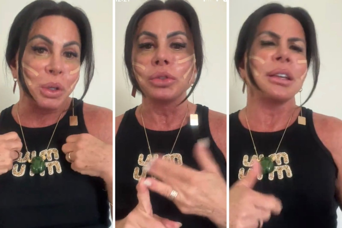 Gretchen remove PMMA dos lábios e explica por que cancelou o lifting facial